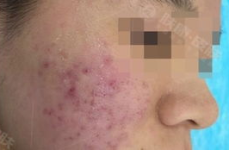 哪个医院治疗青春痘好,治疗青春痘效果显著的医院推荐